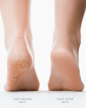 Nuvé™ Silk 3 Pro — Electronic Callus Remover (Salon Feet in 5 Minutes)